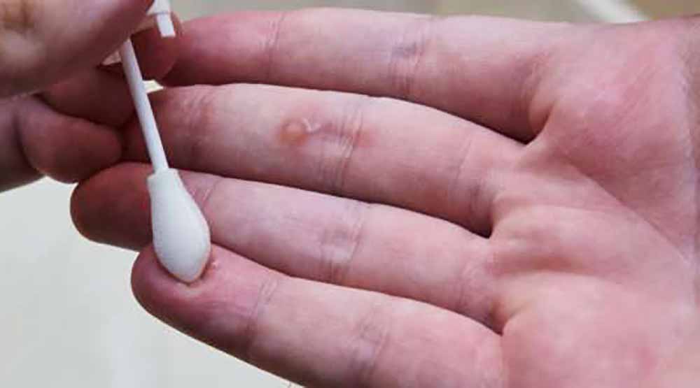 zamrzovanje_bradavic